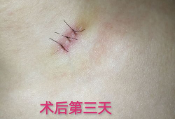 痣切除手术视频全过程,专业操作与术后护理详解